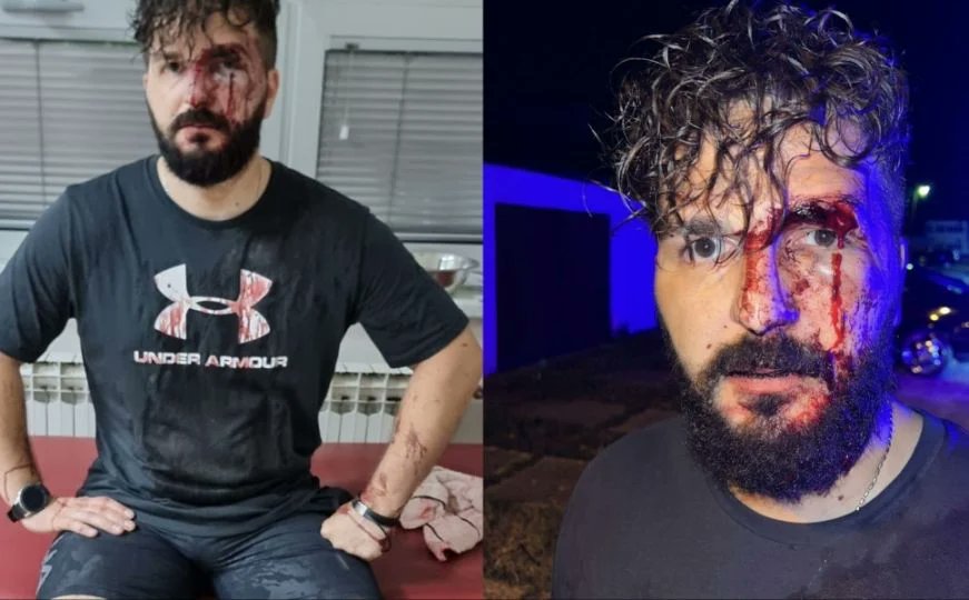 RSF_inter's tweet image. #Bosnia: Journalist Mirza Dervisevic was injured on Saturday night in a knuckleduster attack. The owner of local outlet Times.ba was assaulted in front of his #Brcko apartment. RSF urges the 🇧🇦authorities to bring the perpetrator(s) of the brutal attack to justice.