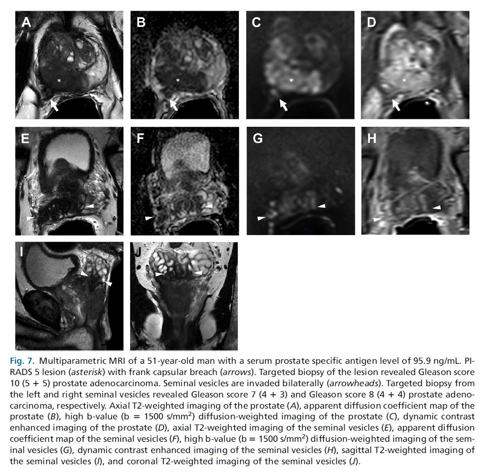 Baris Turkbey MD (@radiolobt) on Twitter photo 📣I am happy to share our new article "Prostate Cancer Local Staging with MRI" sciencedirect.com/science/articl…
🔵Congratulations to @YueXLin Latrice Johnson <a href="/FennessyFiona/">Fiona Fennessy</a>
🟡We really enjoyed while we were writing our paper and we hope you will like when you read it 👍
🔵Thank you 📣I am happy to share our new article "Prostate Cancer Local Staging with MRI" sciencedirect.com/science/articl…
🔵Congratulations to @YueXLin Latrice Johnson <a href="/FennessyFiona/">Fiona Fennessy</a>
🟡We really enjoyed while we were writing our paper and we hope you will like when you read it 👍
🔵Thank you