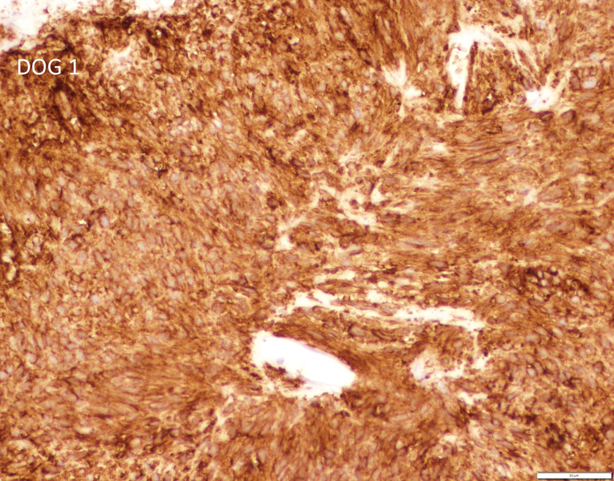 UpstateCytology's tweet photo. This is a gastrointestinal stromal tumor, which is positive for DOG-1 and CD117 (c-KIT). Differentials include a leiomyoma (SMA+) and schwannoma (S100+). Thanks for participating! https://t.co/dZEUDUuqp9