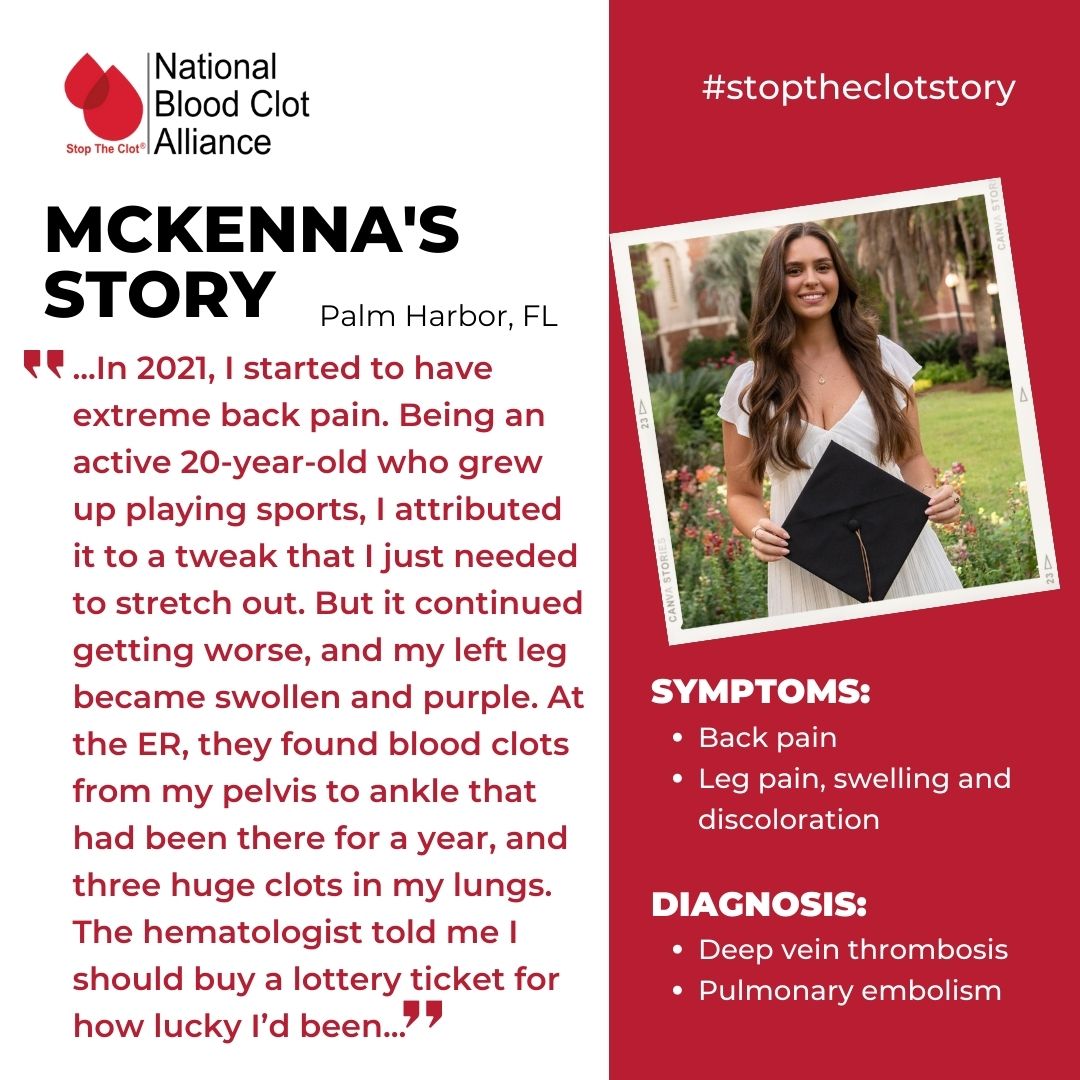 StopTheClot's tweet photo. "During my week in the hospital, I went through two #thrombectomy procedures. Doctors also discovered that I have #MayThurnerSyndrome & #FactorII heterozygous clotting disorder." Full story: https://t.co/AAyFBjT1t5
#stoptheclot #stoptheclotstory #mts #birthcontrol https://t.co/qRUiibNJG3