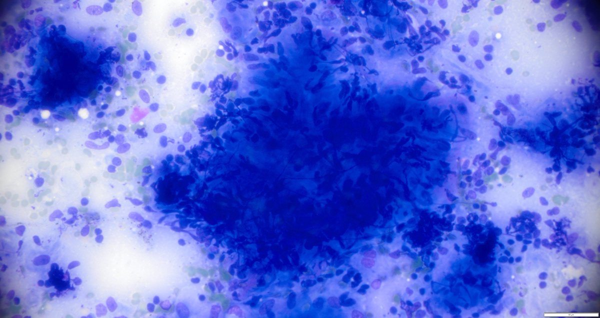 UpstateCytology's tweet photo. FNA of a hilar lymph node from a 40 yo female with hilar lymphadenopathy. What is pictured here? What are your differentials? #PathTwitter #cytology #cytopath #cytopathology https://t.co/NUos2UsK8B