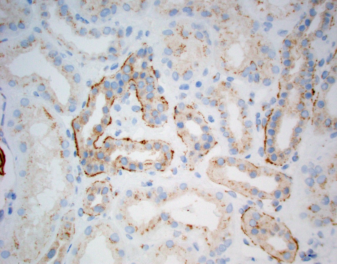 Anyone encounter TBM deposits with NELL-1+ membranous nephropathy? IF is IgG. IHC is NELL-1. #renalpath #pathtwitter