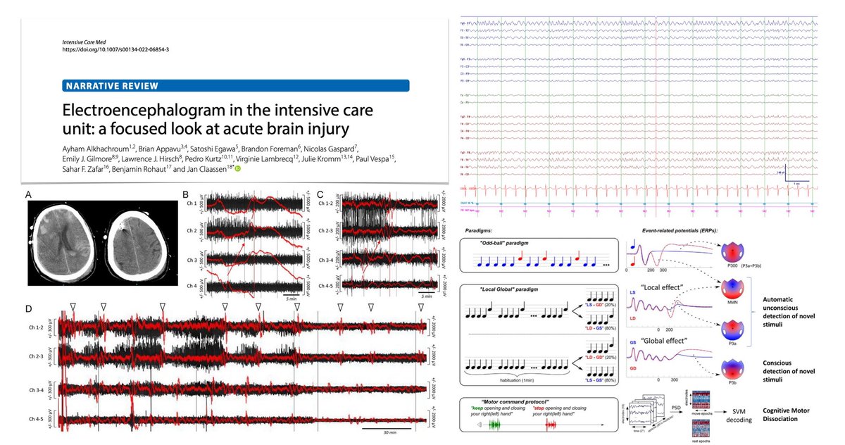 yourICM's tweet image. 🧠 Here recent neuro-narrative reviews… 🔓 #FOAMcc on @yourICM 
📖 EEG in #ICU for acute BI rdcu.be/dj1PO
📖 Managing moderate/severe TBI rdcu.be/cN2rq
📖 Hypoxic–ischaemic BI after CA rdcu.be/dh3Gd
📖 The brain in #PedsICU  rdcu.be/cLS1v