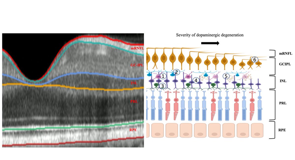 Eric Topol (@erictopol) on Twitter photo Picking up the risk of #Parkinson's disease an average 7 years before clinical presentation via #AI of eye scans!
n.neurology.org/content/early/⦠<a href="/GreenJournal/">Neurology Journal</a> <a href="/sktywagner/">Siegfried Wagner</a> <a href="/pearsekeane/">Pearse Keane</a> @UCLEye <a href="/Moorfields/">Moorfields Eye Hospital NHS Foundation Trust</a> pleased to be a co-author of this exceptional work Picking up the risk of #Parkinson's disease an average 7 years before clinical presentation via #AI of eye scans!
n.neurology.org/content/early/⦠<a href="/GreenJournal/">Neurology Journal</a> <a href="/sktywagner/">Siegfried Wagner</a> <a href="/pearsekeane/">Pearse Keane</a> @UCLEye <a href="/Moorfields/">Moorfields Eye Hospital NHS Foundation Trust</a> pleased to be a co-author of this exceptional work