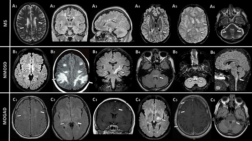 Can you tell the difference between #multiplesclerosis NMO and MOG with #neuroimaging? Treatments have rapidly evolved, making accurate diagnosis crucial. Read this review to test your skills and learn more. #neurology #neurorad #radres #neurotwitter onlinelibrary.wiley.com/doi/10.1111/jo…
