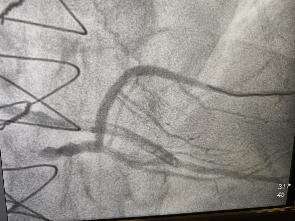 MarekRadomski71's tweet photo. #CardioTwitter #tortuous #ChipPCI 67yo małe with NSTEMi, PCI LAD and CABG LiMA-Diag-LAD and Ao-RDP 2017. Now occlusion in prox RCA and critical RPL. Jad to use bypass to fix it. https://t.co/vGUr8To2pO