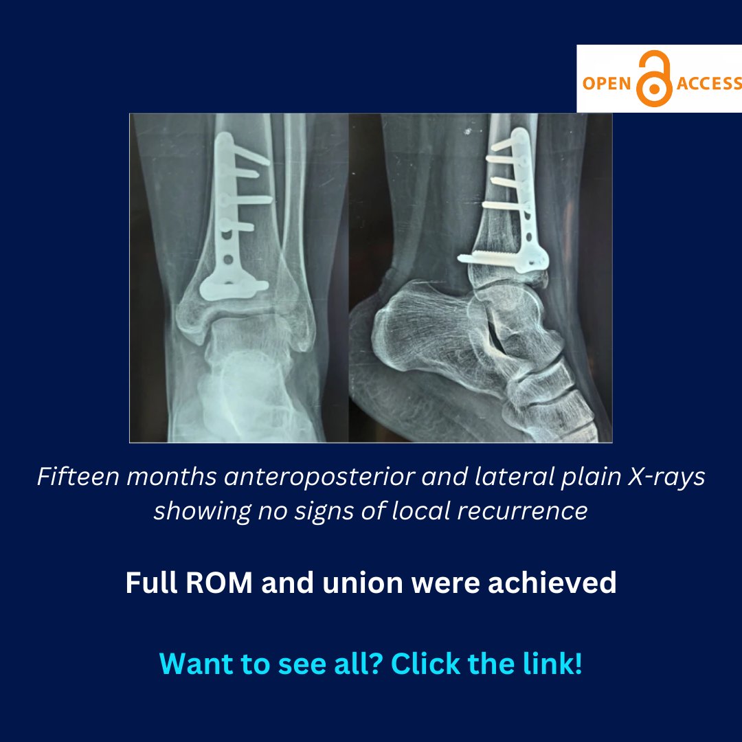 JEO_journal's tweet photo. How to treat massive cysts or bone tumors in articulating surfaces?
Check out this case report on using autologous iliac crest bone grafts as an option, open-access at: https://t.co/sODf9LVIBX
#JEO #bonecysts #autologousbone https://t.co/SKDLMaqfGI