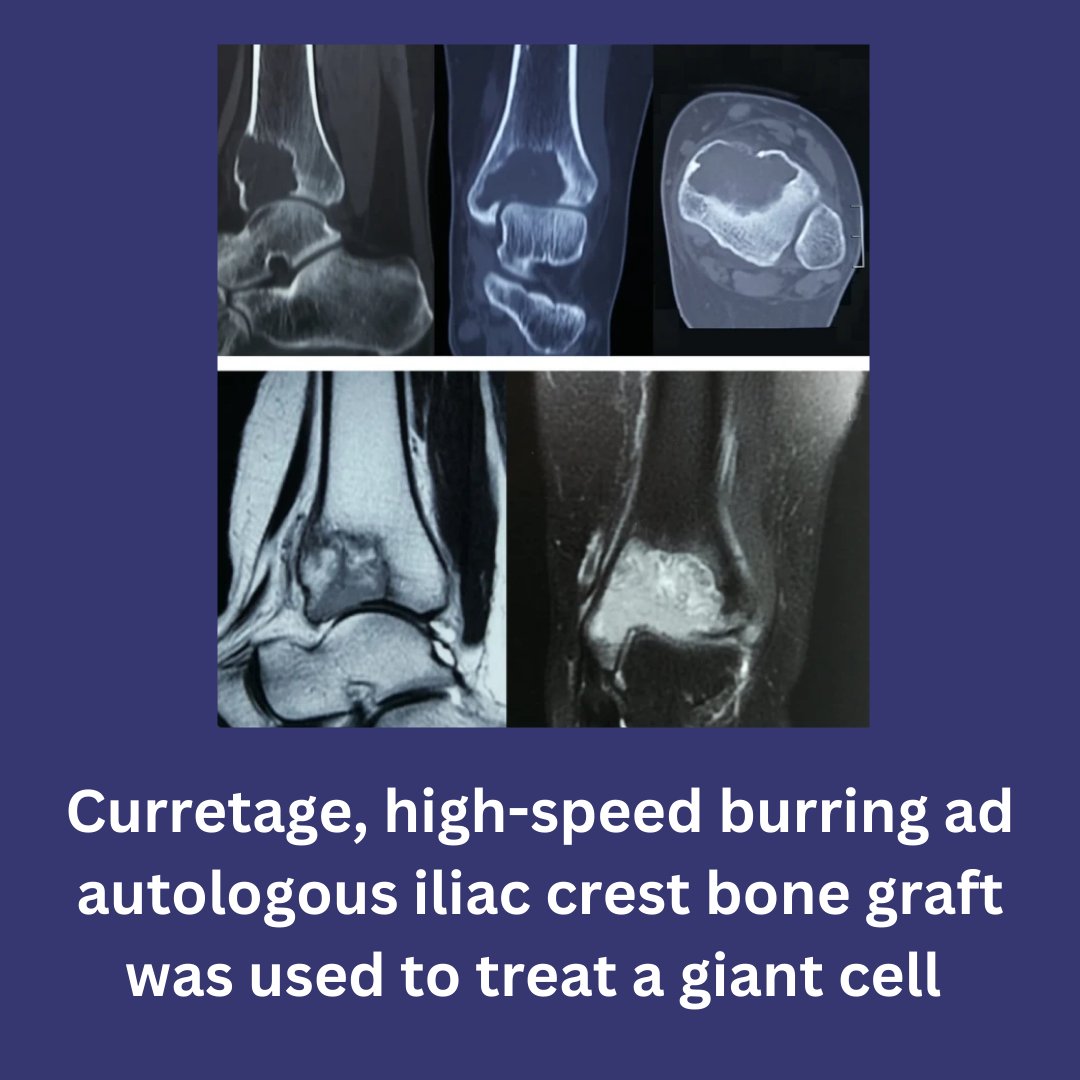 JEO_journal's tweet photo. How to treat massive cysts or bone tumors in articulating surfaces?
Check out this case report on using autologous iliac crest bone grafts as an option, open-access at: https://t.co/sODf9LVIBX
#JEO #bonecysts #autologousbone https://t.co/SKDLMaqfGI