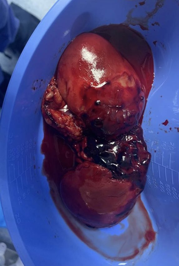 Trauma renal grado 5 de la AAST: secundario a trauma contuso durante una  🍻 🍺 🤯 <a href="/omarvic18/">omar</a> <a href="/OGomezAbrajan/">Omar Gómez Abraján 🇲🇽</a> <a href="/erenhu_gonzalez/">Orión Erenhú Rodríguez</a> <a href="/BrenaniSu/">Bren Suaste</a> <a href="/cristobalmd02/">Dr Cristobal Diaz•Urólogo</a> <a href="/chrisnaval13/">Christian Aarón Martínez Flores</a> #UroHCM enfatizar siempre el manejo adecuado  del trauma por el urólogo
