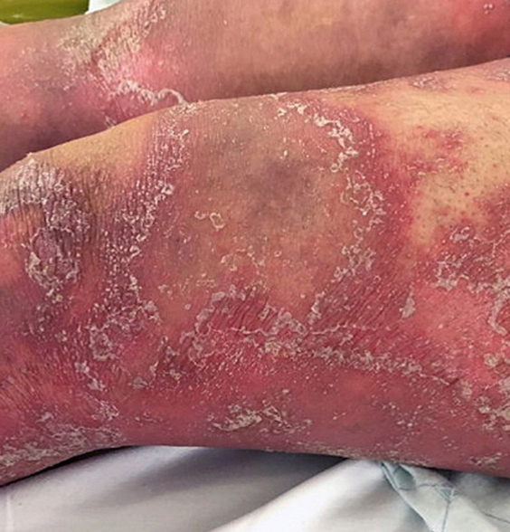AADmember's tweet photo. A @JAADJournals research letter assessed risk factors for development of generalized #pustularpsoriasis, including lifestyle factors, psychiatric comorbidities, and systemic corticosteroid exposure. #DermWorldWeekly ➡️ https://t.co/92qtx2onCx https://t.co/fwGoafYtkt