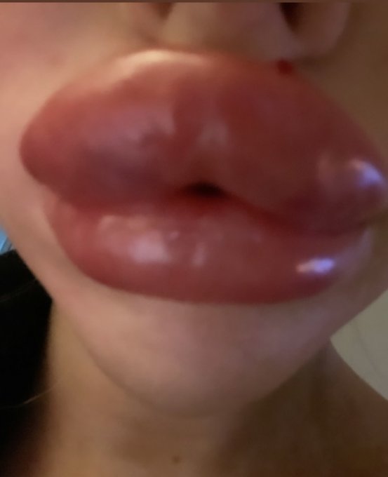 Do you like girls with big lips 👄   #fakelips #lipfiller https://t.co/hXIyVsF8Aa<a href="/tag/fakelips"class="tags">#fakelips</a><a href="/tag/lipfiller"class="tags"><span>#lipfiller</span></a>