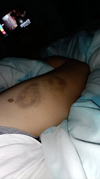 Damn it's soo stuffy in bed tonight 🥵  #hot #bruised #Canes #leg #bed #beautifulmarks #daddy https://t<a href="/tag/hot"class="tags">#hot</a><a href="/tag/bruised"class="tags">#bruised</a><a href="/tag/bed"class="tags"><span>#bed</span></a><a href="/tag/leg"class="tags"><span>#leg</span></a><a href="/tag/daddy"class="tags"><span>#daddy</span></a><a href="/tag/canes"class="tags"><span>#canes</span></a><a href="/tag/beautifulmarks"class="tags"><span>#beautifulmarks</span></a>