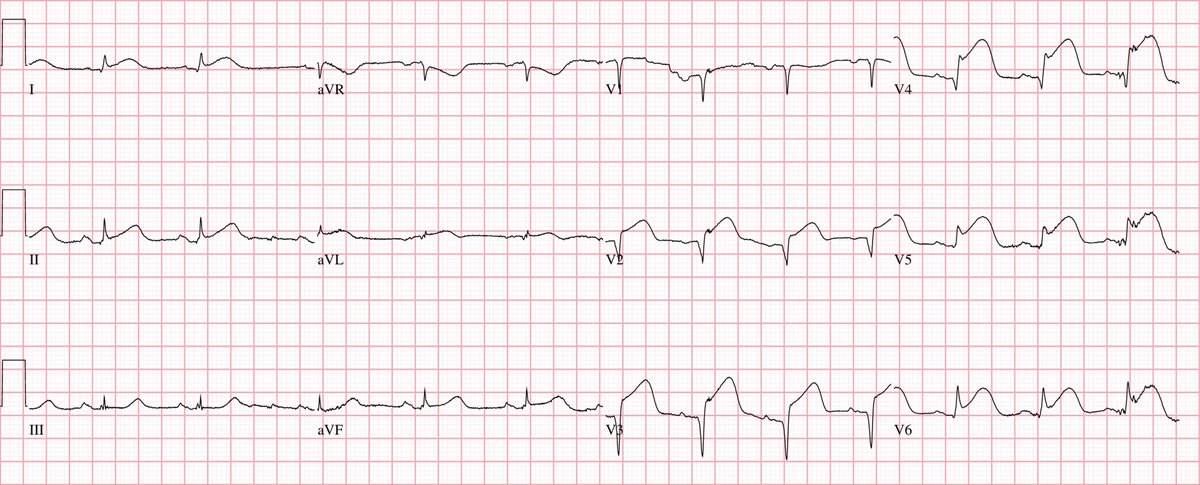 EM_RESUS's tweet photo. Here’s an impressive #ECG recorded in a 65-year-old man after crashing his truck into a tree. He has severe chest pain and no memory of the event.

What’s the diagnosis?
How would you proceed? https://t.co/oJtQwdBy4q