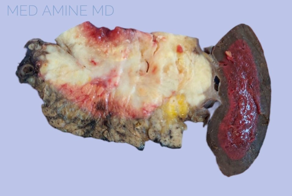 #PathTwitter #pathologists #pathology #pathTwitter #grosspath