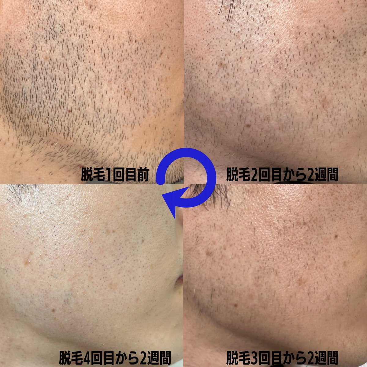 OKMEC_ORIO's tweet photo. ヒゲ脱毛前と2回目～4回目までの写真です‼️
✅ヒゲ脱毛5回コース
122,500円(税込)
今なら20%offで
98,000円(税込)で施術しています✨
使用機械はGentleMaxProPlus⚙️
ヒゲ脱毛が気になる…👀✨という方はぜひお問い合わせください😄
 #医療脱毛
 #メンズ脱毛
 #九州メンズ医療脱毛クリニック 
 #折尾 https://t.co/hHpKzjle8T