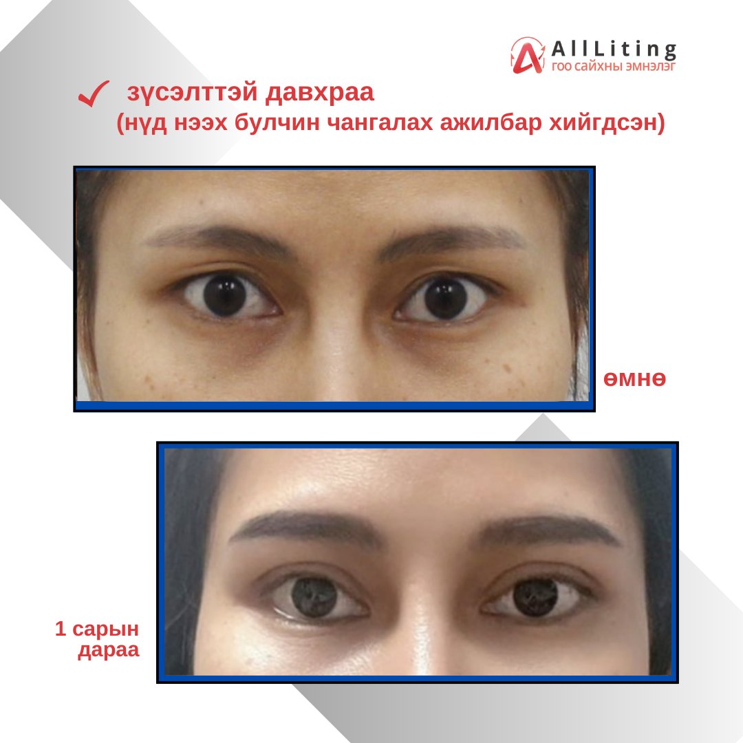 #БОДИТ_ҮР_ДҮН #ДАВХРАА
хийлгэсэн ажилбар
📷зүсэлттэй давхраа
(нүд нээх булчин чангалах ажилбар хийгдсэн)
-------------------------------
📷📷 ҮЗЛЭГ/ЗӨВЛӨГӨӨ үнэгүй хийж зөвхөн таньд тохирсон мэс заслын төлөвлөгөөг гаргана.
📷монгол ажилтан: 010-4931-4451