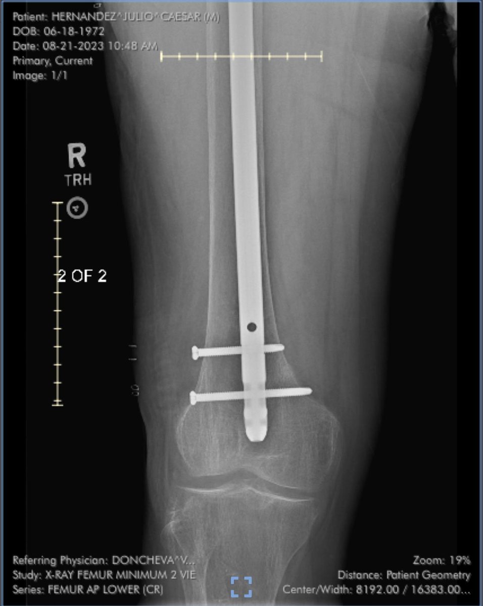 no_funeral's tweet photo. My guitarist in @SpaztikBand has been in a lot of pain for a long time &amp; back in February we finally had to go on indefinite hiatus because he couldn't make it to gigs anymore. They finally found a big part of the cause.

Plz share or donate if you can
https://t.co/yEGO5RAKLF https://t.co/iQuebj3cJ0