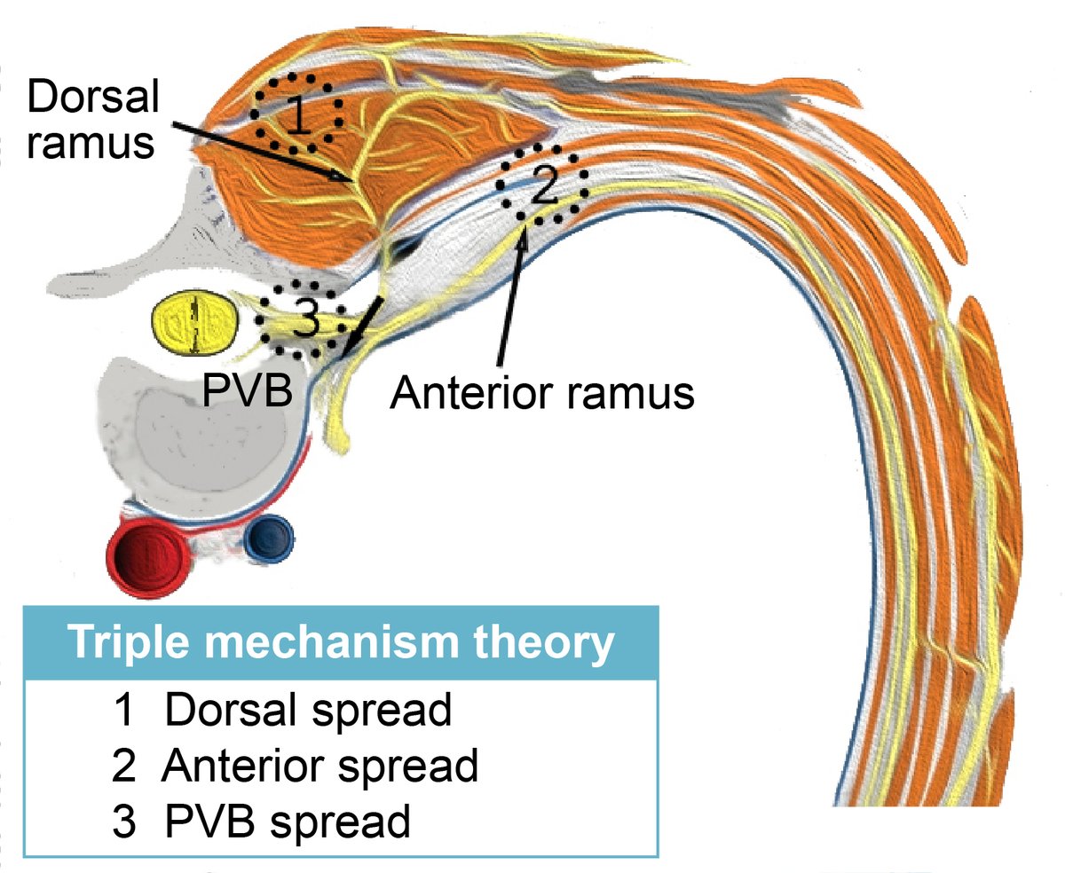 journal_aps's tweet photo. Welcome to reading the new perspective authored by Dr. @Steve_Coppens et al.
Stranger things: the erector spinae block, extra sensory perception, or paranormal block by proxy?
#regionalanesthesia #anesthesia #ESPB #painmanagement #acutepain
https://t.co/Kral21bQh4 https://t.co/0ICWkIQLSh