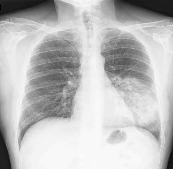 Naturall_Killer's tweet photo. 📌Neumonía típica:
➖Fiebre, tos productiva, consolidación pulmonar.
✅Rx: Condensación lobar que puede ir o no acompañado de derrame pleural
📌Neumonía atípica:
➖Disnea, tos escasa no productiva
✅Rx: Infiltrado intersticial difuso, sin condensaciones o con infiltrados
#ENARM⚕ https://t.co/0xpur80sIz