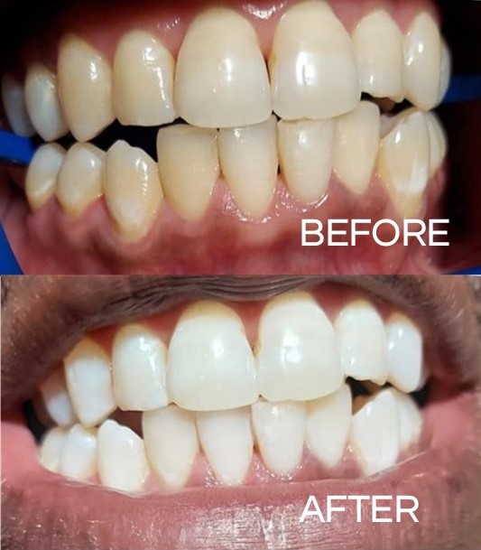 thetooth_dr's tweet photo. The before photo is of a patient with stained teeth. The after photo was achieved with a dental whitening procedure.
#flossdental #thetoothdr #flossboss #beforeandafter #stainedteeth #dentalwhitening #higginbothamfamilydental #oralhygiene #dentist #dentistry #trinidadandtobago https://t.co/kSMprxOlTh