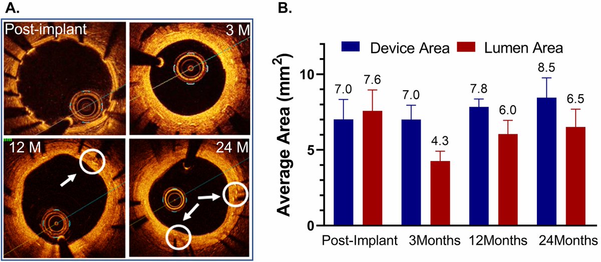RCMjournal's tweet photo. #RCM-Vol. 24 No. 8
🌈Original Research
Final 36-Month Outcomes from the Multicenter DynamX Study Evaluating a Novel Thin-Strut Novolimus-Eluting Coronary Bioadaptor System and Supporting Preclinical Data
#OCT #CAD #DES #Bioadaptor #Coronary #lesion
🔎
https://t.co/e7weOTsbVa https://t.co/O5rAbAGhJH