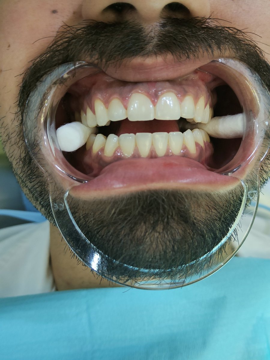 AbdullahBuhairi's tweet photo. @DENTAL_ENT اشكر الاخ المراجع على موافقته لتصوير الفيديو
والشكر موصول للدكتور محمد ال عمر لدعمه ومساندته اثناء الجراحة https://t.co/9hw1VJoVCP