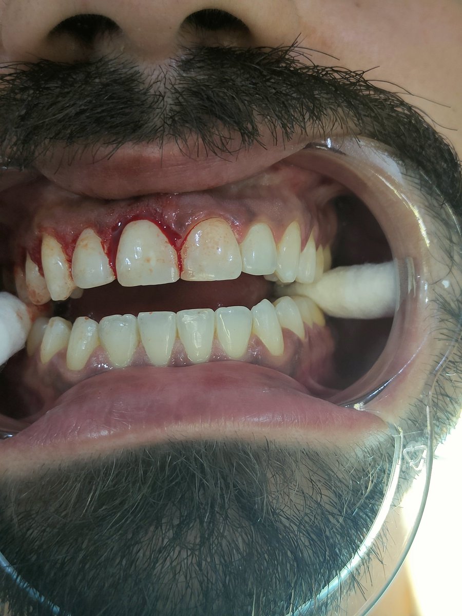 AbdullahBuhairi's tweet photo. @DENTAL_ENT اشكر الاخ المراجع على موافقته لتصوير الفيديو
والشكر موصول للدكتور محمد ال عمر لدعمه ومساندته اثناء الجراحة https://t.co/9hw1VJoVCP