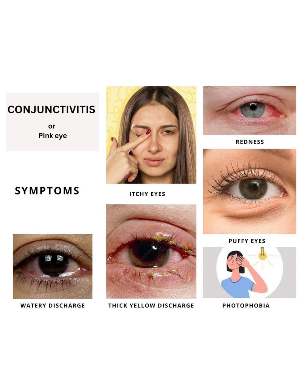 Health Advisory - Conjunctivitis (colloquially called as Eye Flu) -Issued by National Programme for Control of Blindness & Visual Impairment (NPCB&VI), National Health Mission, Mizoram