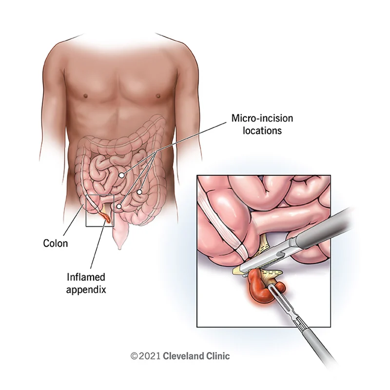 UniversalSurge1's tweet photo. #Appendicectomy remains #treatment of choice for patients with #acute #appendicitis 
Read more: https://t.co/HwNkRHwvpJ 
share your paper on: https://t.co/7f9IQq9XFt
#ipjus 
#manuscript 
#reseach 
#Appendix #Surgery https://t.co/6EP9ltklv7