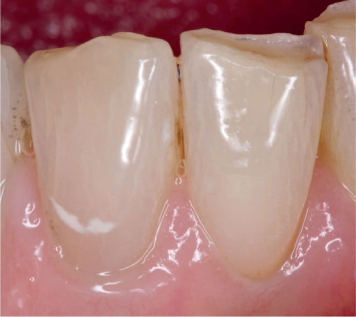 Have you read the second installment of our series on mineralization technologies? 

Start preventing and managing early caries with mineralizing agent technologies! 

Learn more about their availability, properties, and clinical uses in our new article: dental-update.co.uk/content/restor…