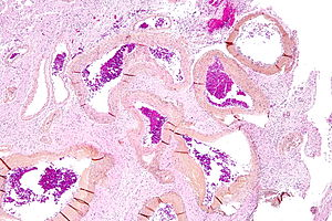 StrokeResearch2's tweet photo. #An arteriovenous malformation (AVM) is an abnormal connection between arteries and veins, bypassing the capillary system
https://t.co/yBwh9ptUCK https://t.co/OB3GGxoed9