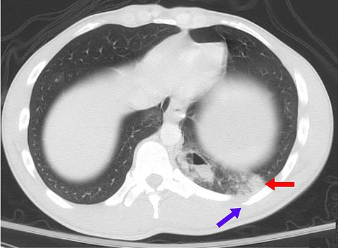 StrokeResearch2's tweet photo. #Pulmonary arteriovenous malformations are abnormal communications between the veins and arteries of the pulmonary circulation, leading to a right-to-left blood shunt
https://t.co/yBwh9ptUCK https://t.co/Mzg2p3tyxu