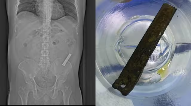 bangloreshor's tweet photo. 😳WTF... Bengaluru man Swallows nail-cutter, forgets for 8 years, get it removed.  "For all these years, I did not tell my parents or sisters, assuming they would scold me. Even after marriage, I did not inform my wife as there was no pain and I just forgot about it," said Ramesh https://t.co/ti3yjCZ147