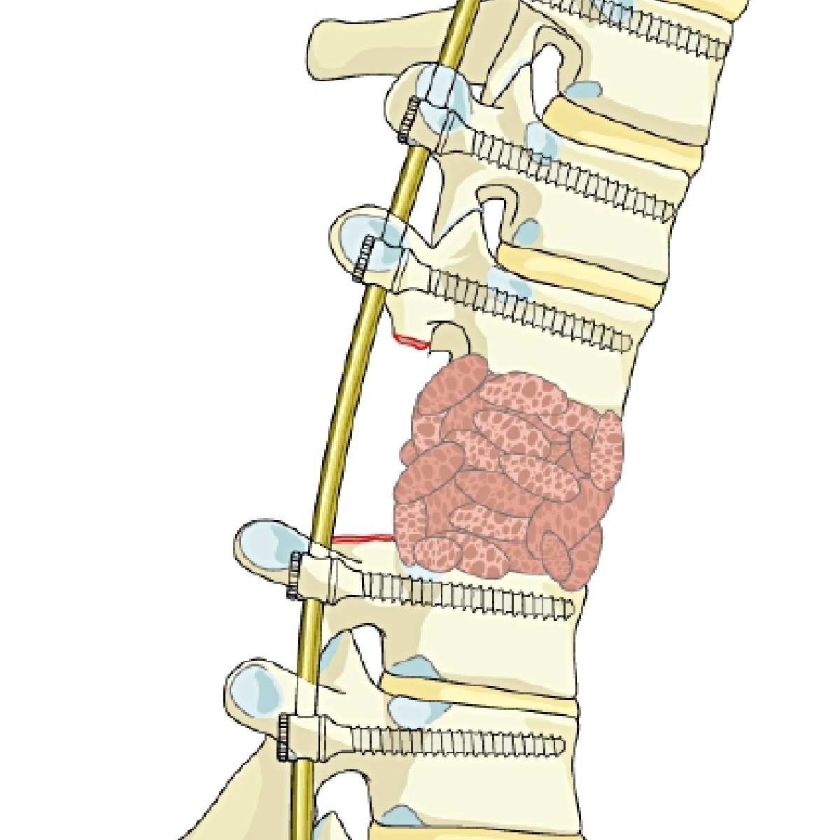 AOSurgery's tweet photo. Exciting news for #SpineSurgeons! 🌟 Primary spine tumors module now live! Dive into treatments for benign and malignant tumors across all spine segments. Elevate your expertise with expert insights. #AOReference #AOSpine #MedicalInnovation
Read more: https://t.co/uLDur7mZwX https://t.co/EZwWccx6lS