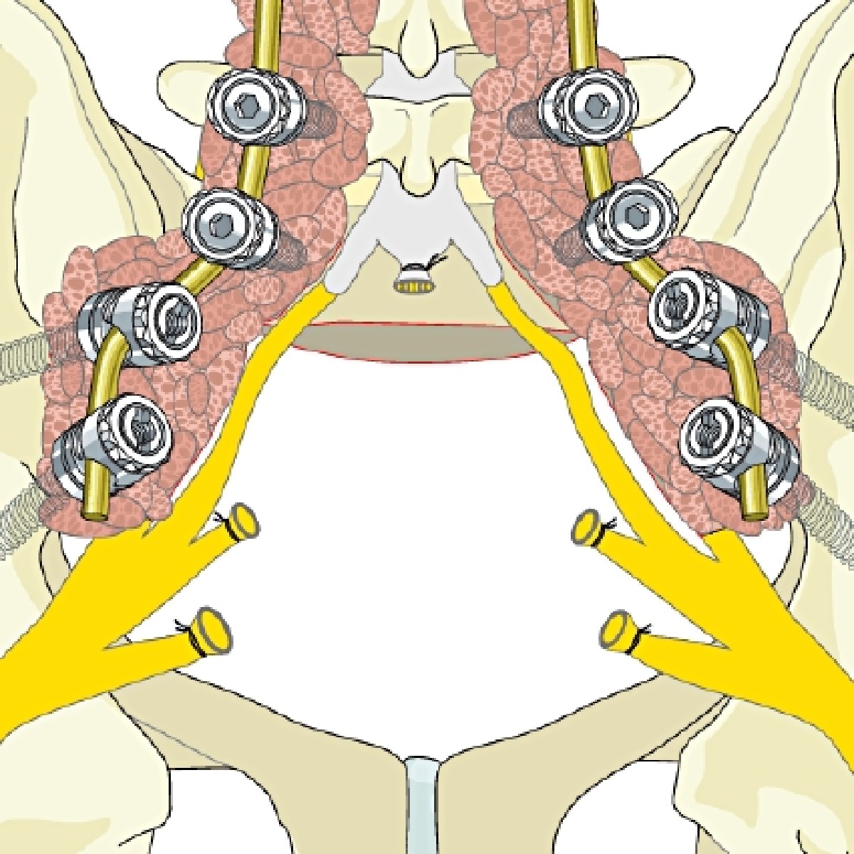 AOSurgery's tweet photo. Exciting news for #SpineSurgeons! 🌟 Primary spine tumors module now live! Dive into treatments for benign and malignant tumors across all spine segments. Elevate your expertise with expert insights. #AOReference #AOSpine #MedicalInnovation
Read more: https://t.co/uLDur7mZwX https://t.co/EZwWccx6lS