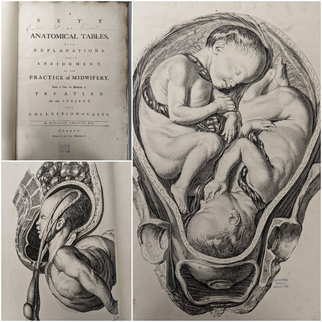 William Smellie's 'A sett of anatomical tables' (1754) is a collection of anatomical drawings depicting pregnancy and childbirth. Only 100 copies of this first edition were produced. Ground breaking in its detail and accuracy, Smellie is known as the father of British midwifery.