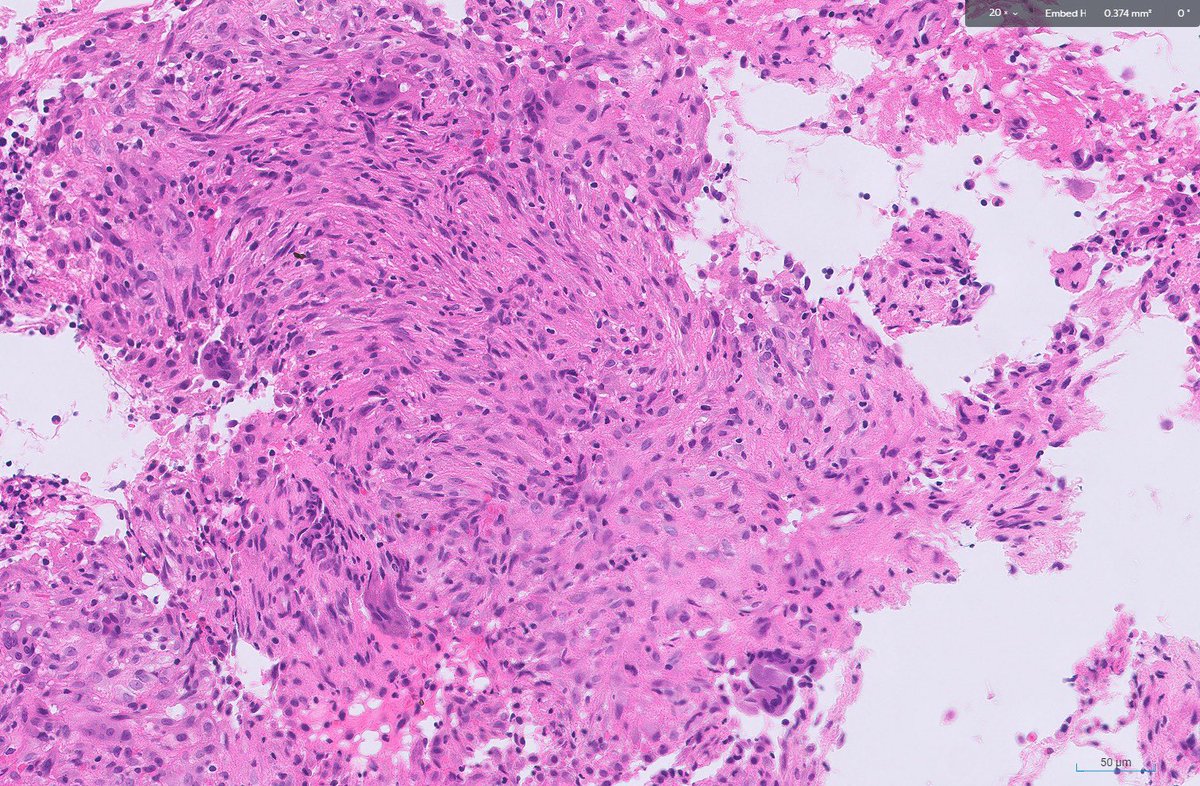 RawiaMo57385655's tweet image. Femur mass 16 yrs old 
#pathtwitter #pathology #pathfamily