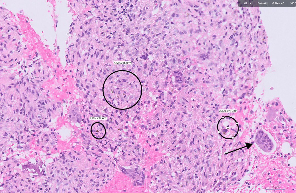 RawiaMo57385655's tweet image. Femur mass 16 yrs old 
#pathtwitter #pathology #pathfamily