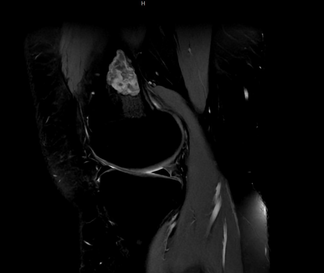 RawiaMo57385655's tweet image. Femur mass 16 yrs old 
#pathtwitter #pathology #pathfamily