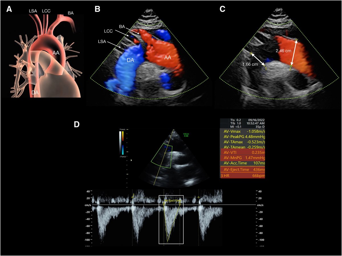 AJOG_thegray's tweet photo. Assessing maternal cardiac function by obstetricians: technique and reference ranges - Measurement of the ascending and descending aorta and the velocity time integral https://t.co/7dS7lTMFNo https://t.co/zesJyN8TuU
