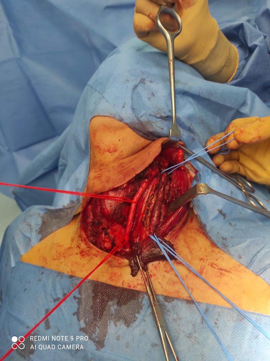 Pedro_Poves's tweet photo. Functional neck dissection in a papillary thyroid neoplasm https://t.co/sZ1KmvhVRz