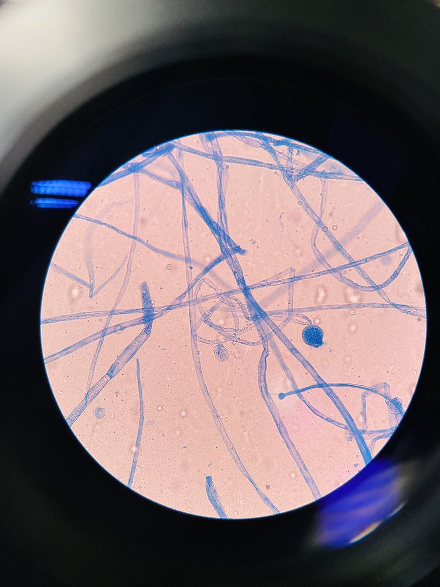 soo_ideal's tweet image. Mucor cirinelloides isolatd 4rm simulatd sinus content 4rm a diabetic patient with sinus pain &amp;amp; headache.They can cause opportunistic disease in imunocompromisd individuals e.g diabetic patients.Mucor spp.are differentiatd 4rm Rhizopus or Rhizomucor spp based on lack of rhizoids