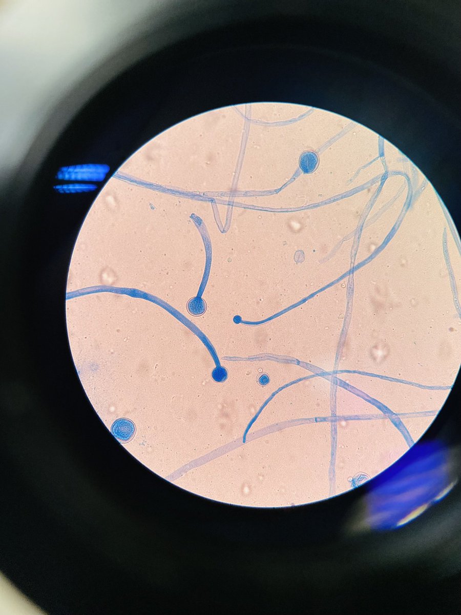 soo_ideal's tweet image. Mucor cirinelloides isolatd 4rm simulatd sinus content 4rm a diabetic patient with sinus pain &amp;amp; headache.They can cause opportunistic disease in imunocompromisd individuals e.g diabetic patients.Mucor spp.are differentiatd 4rm Rhizopus or Rhizomucor spp based on lack of rhizoids