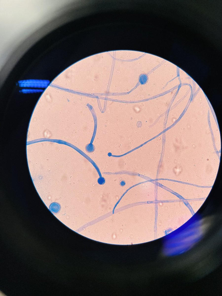 soo_ideal's tweet image. Mucor cirinelloides isolatd 4rm simulatd sinus content 4rm a diabetic patient with sinus pain &amp;amp; headache.They can cause opportunistic disease in imunocompromisd individuals e.g diabetic patients.Mucor spp.are differentiatd 4rm Rhizopus or Rhizomucor spp based on lack of rhizoids