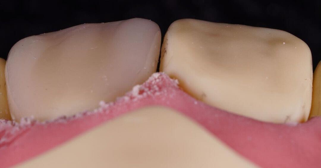 DMGAmerica's tweet photo. Designed to deliver superior esthetics and perfect adaptation with one quick 20-second light cure. Thank you for choosing #Ecosite by DMG @nablouski! #Repost
--
The new DMG Ecosite resin composite, looks promising…
#DMGAmerica #DMGDental #Ecosite #EcositeBond #EcositeBulkFill https://t.co/Ifg9BmWY7F