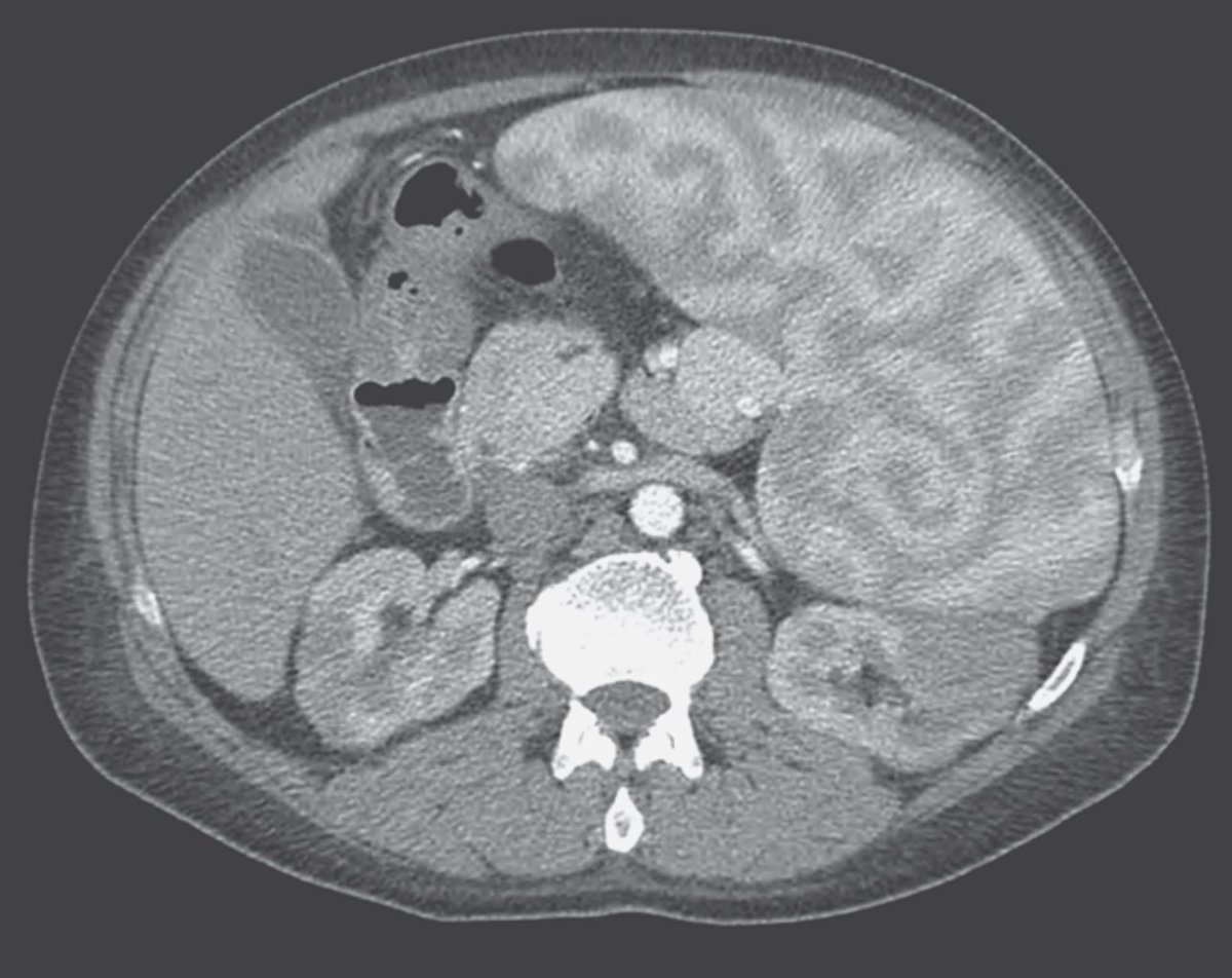 “Brain-like spleen” seen in a patient with anaemia and jaundice. What’s going on here? 🧠