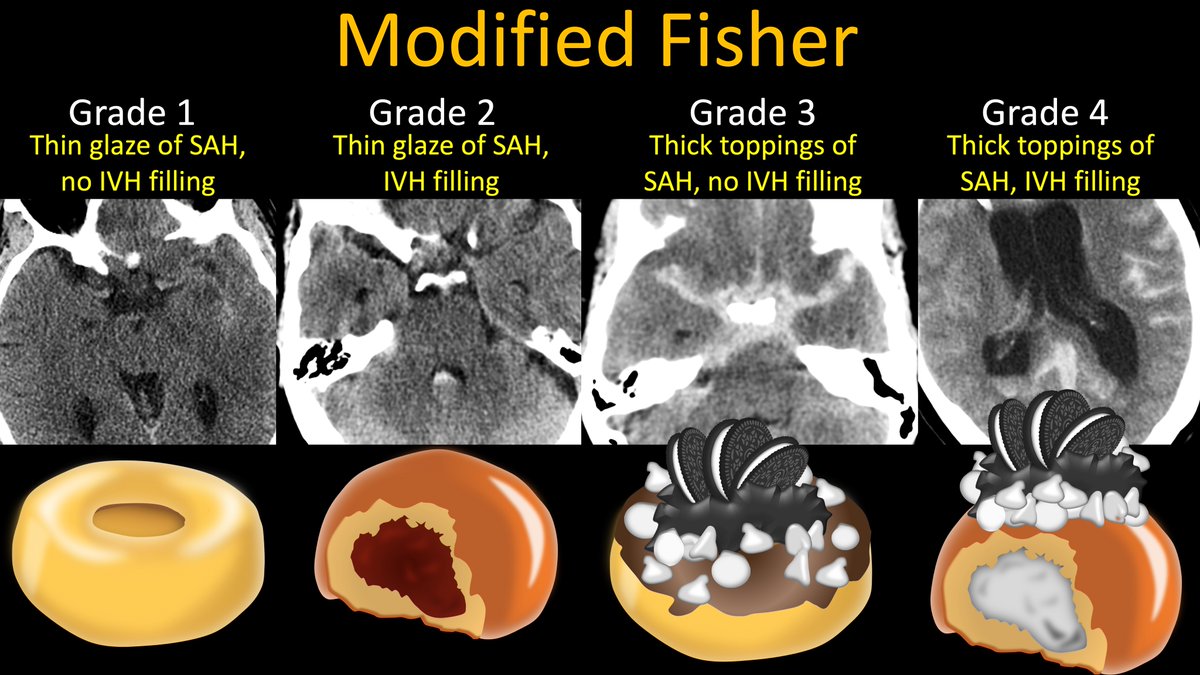 8/So now you can remember the modified Fisher scale by remembering what makes a donut more unhealthy also makes SAH at greater risk of vasospasm. So DONUT worry, you’ve got this!