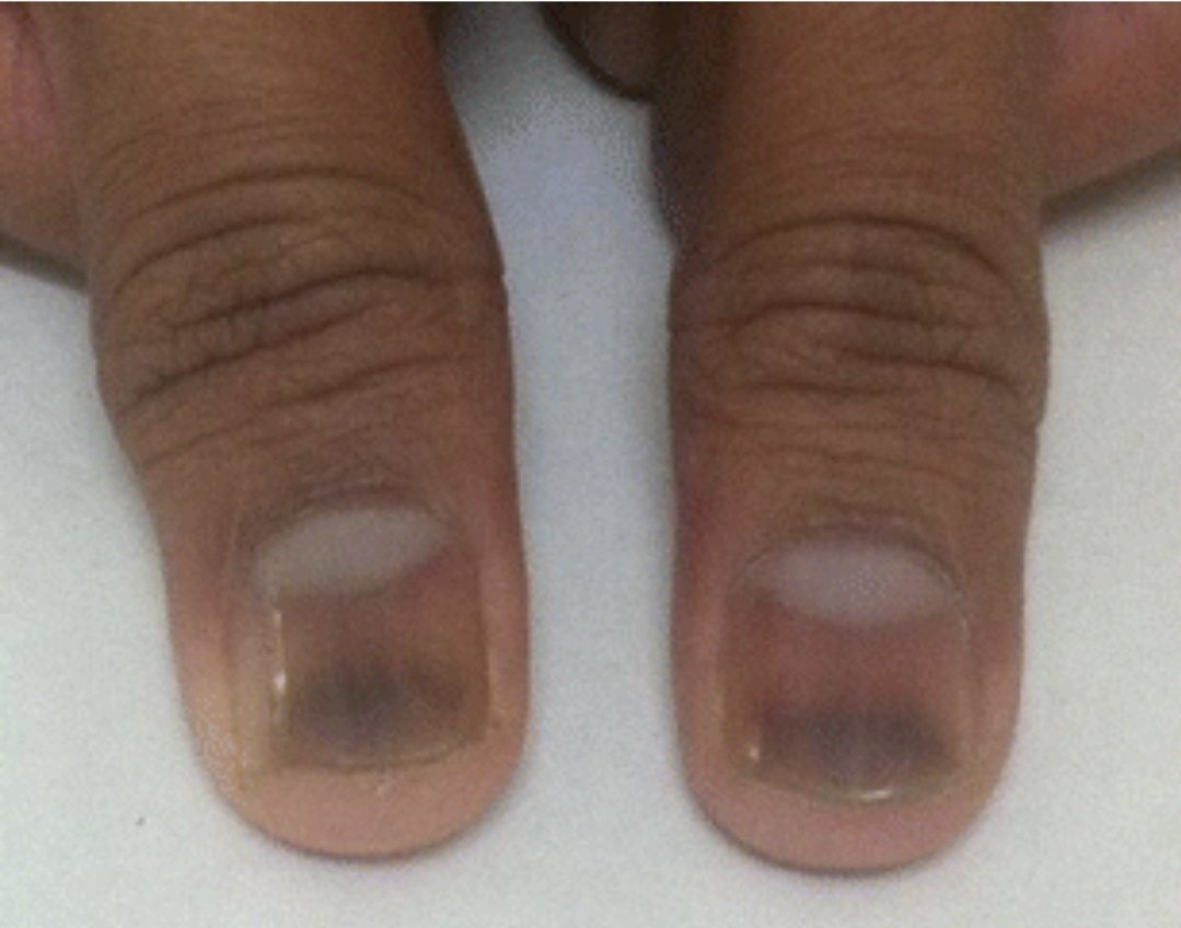 Aggregate 114+ causes of purple nail beds songngunhatanh.edu.vn
