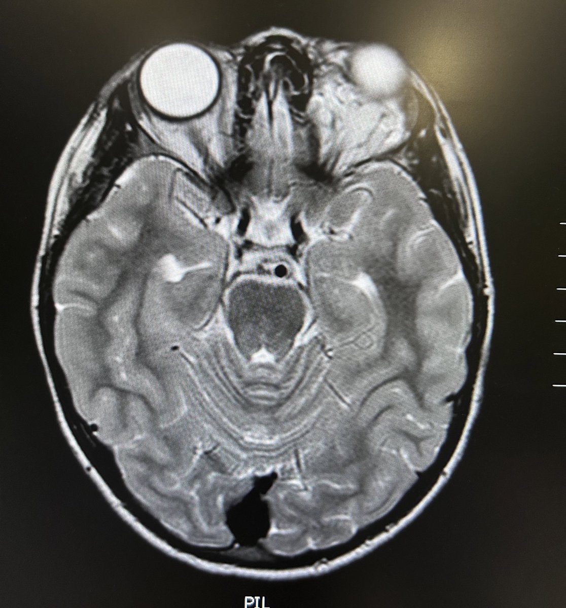 Dtepl's tweet photo. 10 YO girl with a left orbit venolymphatic malformation of the led orbit. Infraorbitary Ultrasound-guided access and #sclero with bleo with xperCT control in the angiosuite https://t.co/YLqZJyaT0B