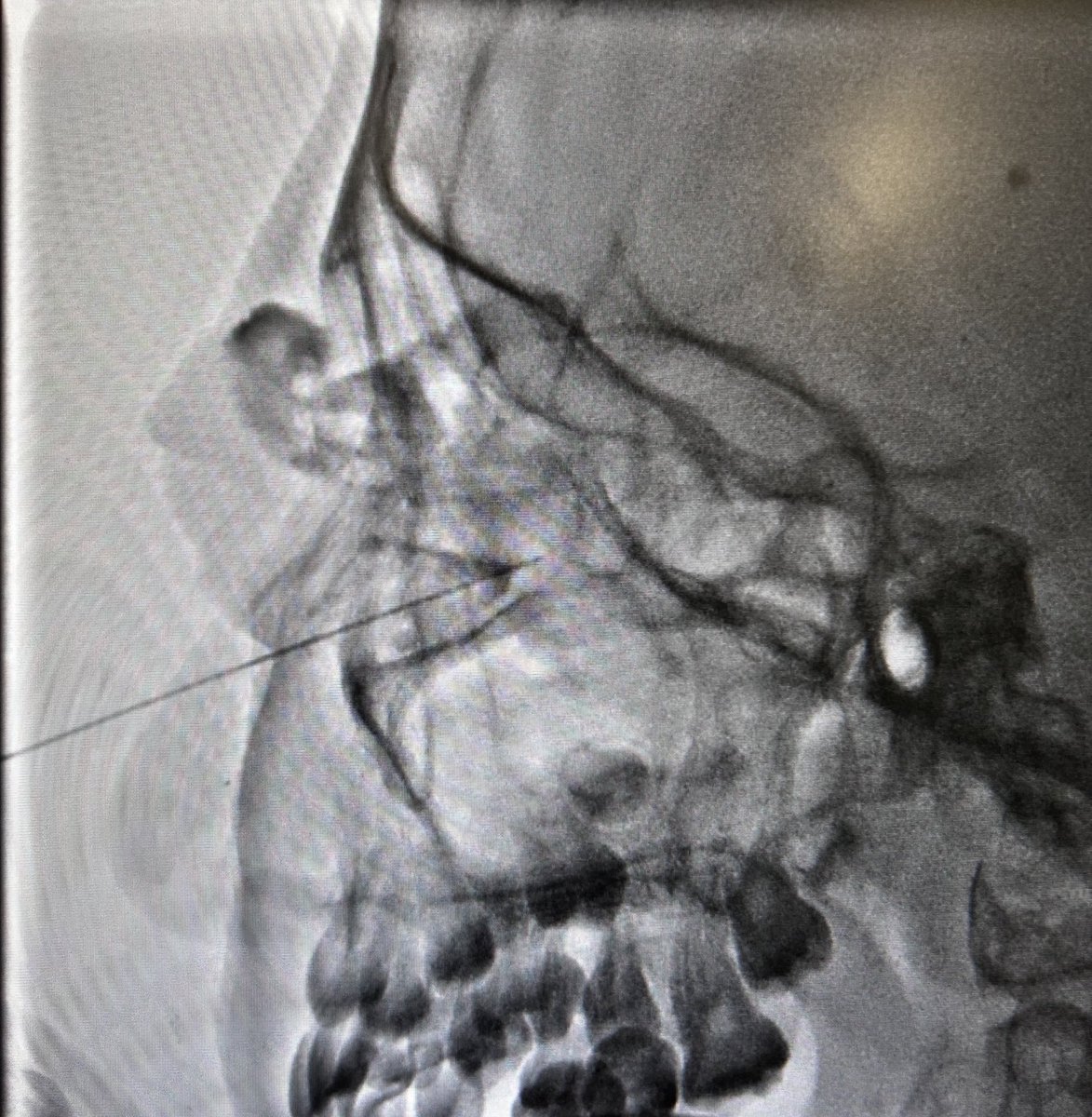 Dtepl's tweet photo. 10 YO girl with a left orbit venolymphatic malformation of the led orbit. Infraorbitary Ultrasound-guided access and #sclero with bleo with xperCT control in the angiosuite https://t.co/YLqZJyaT0B